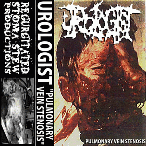 Urologist : Pulmonary Vein Stenosis